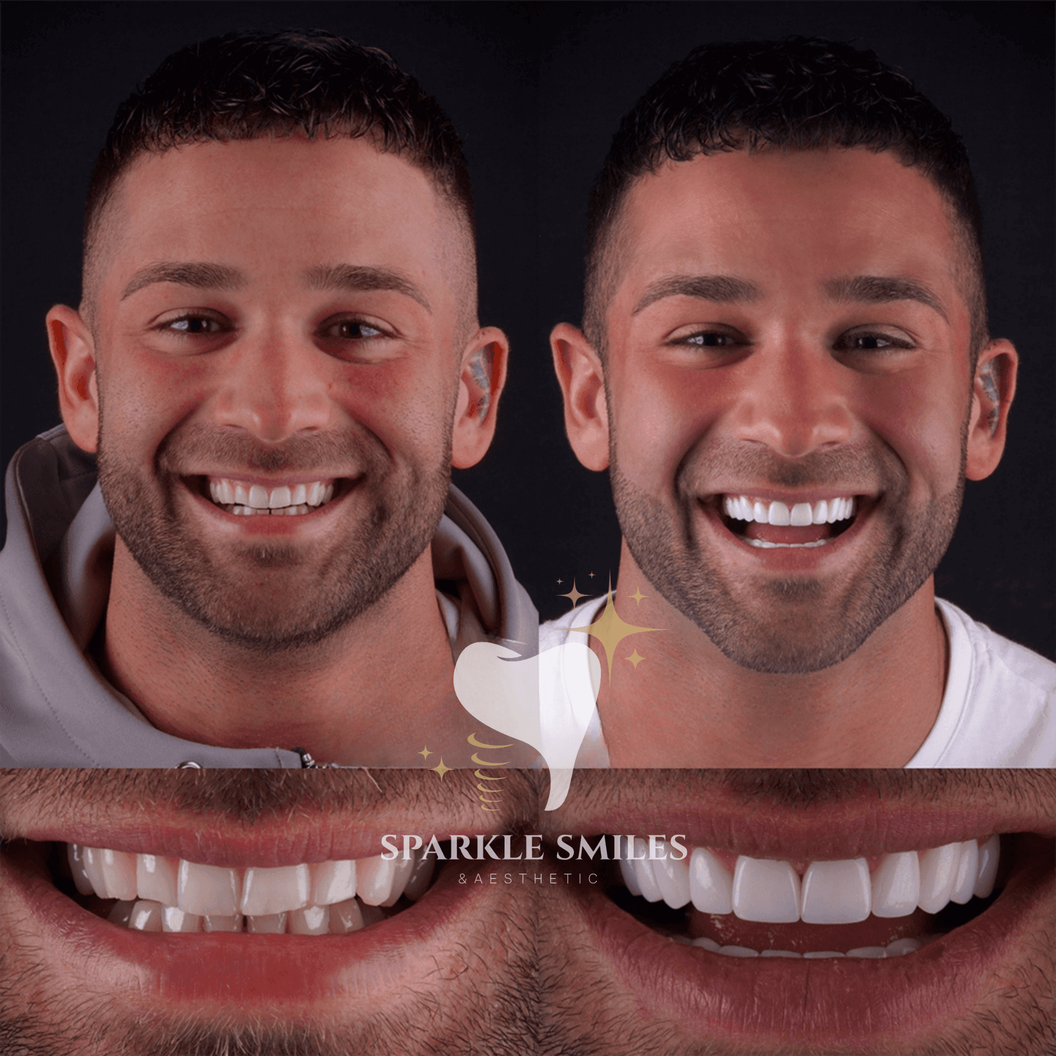 Голливудская улыбка