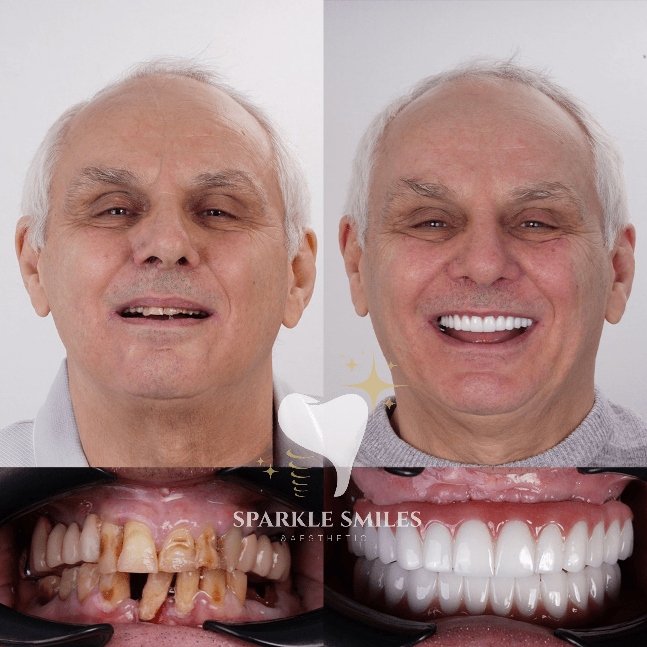 Несъемный протез