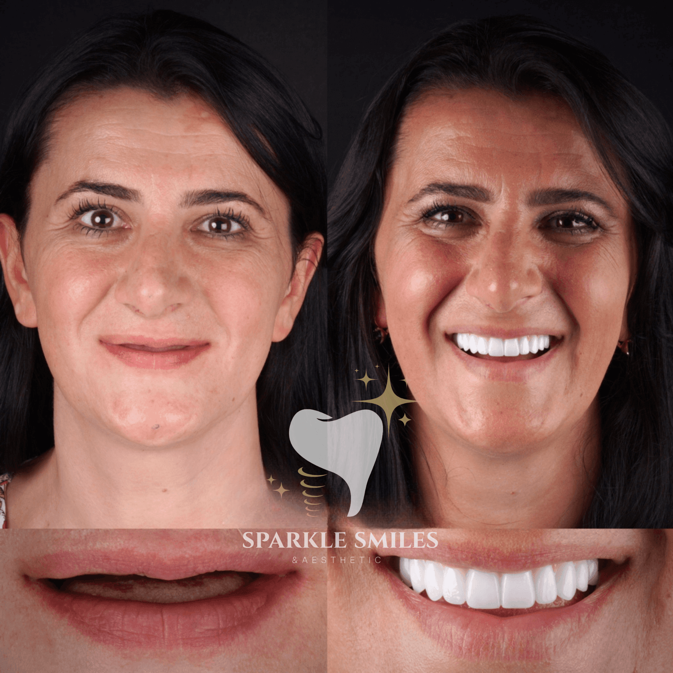 Отсутствие одного зуба