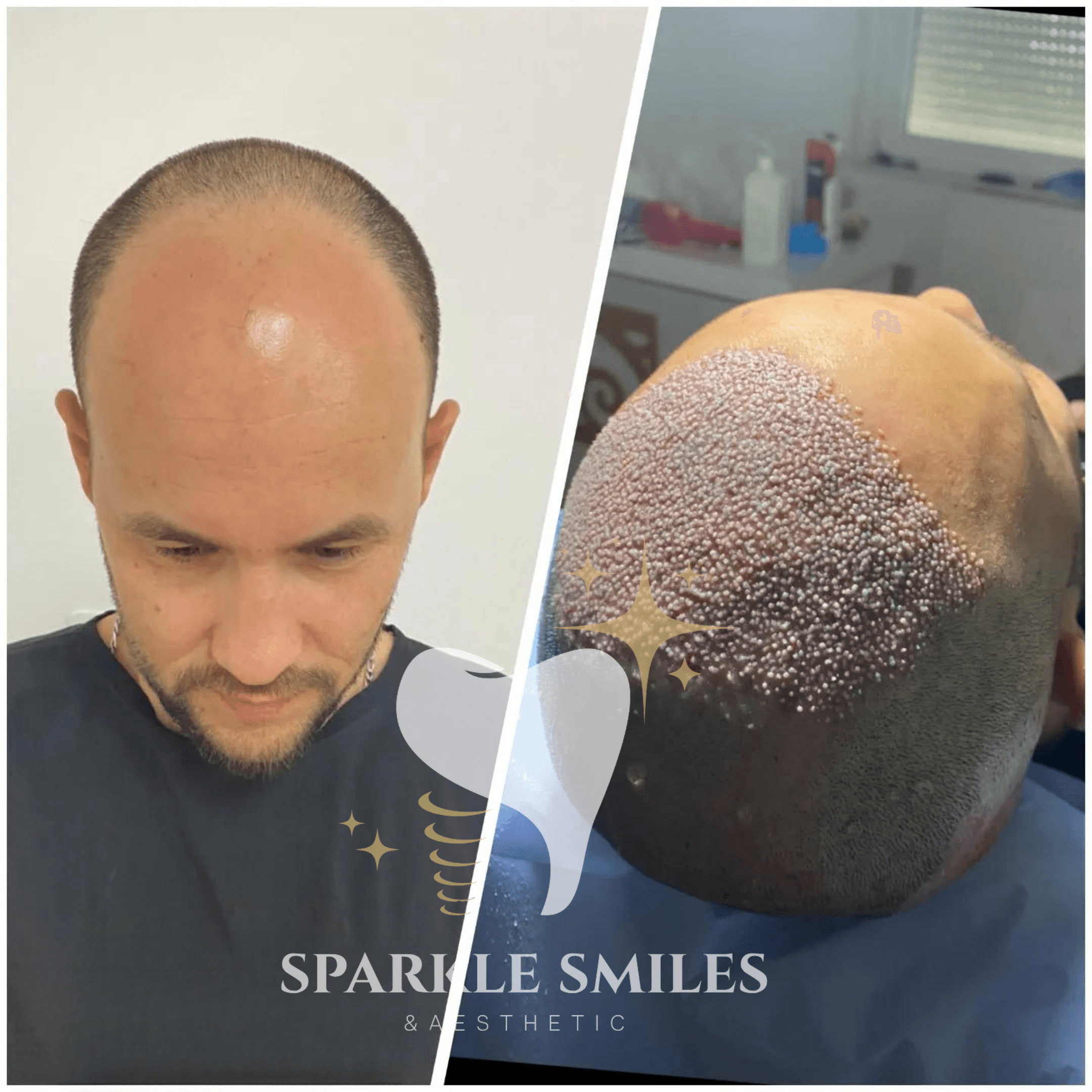 Результат пересадки волос 10