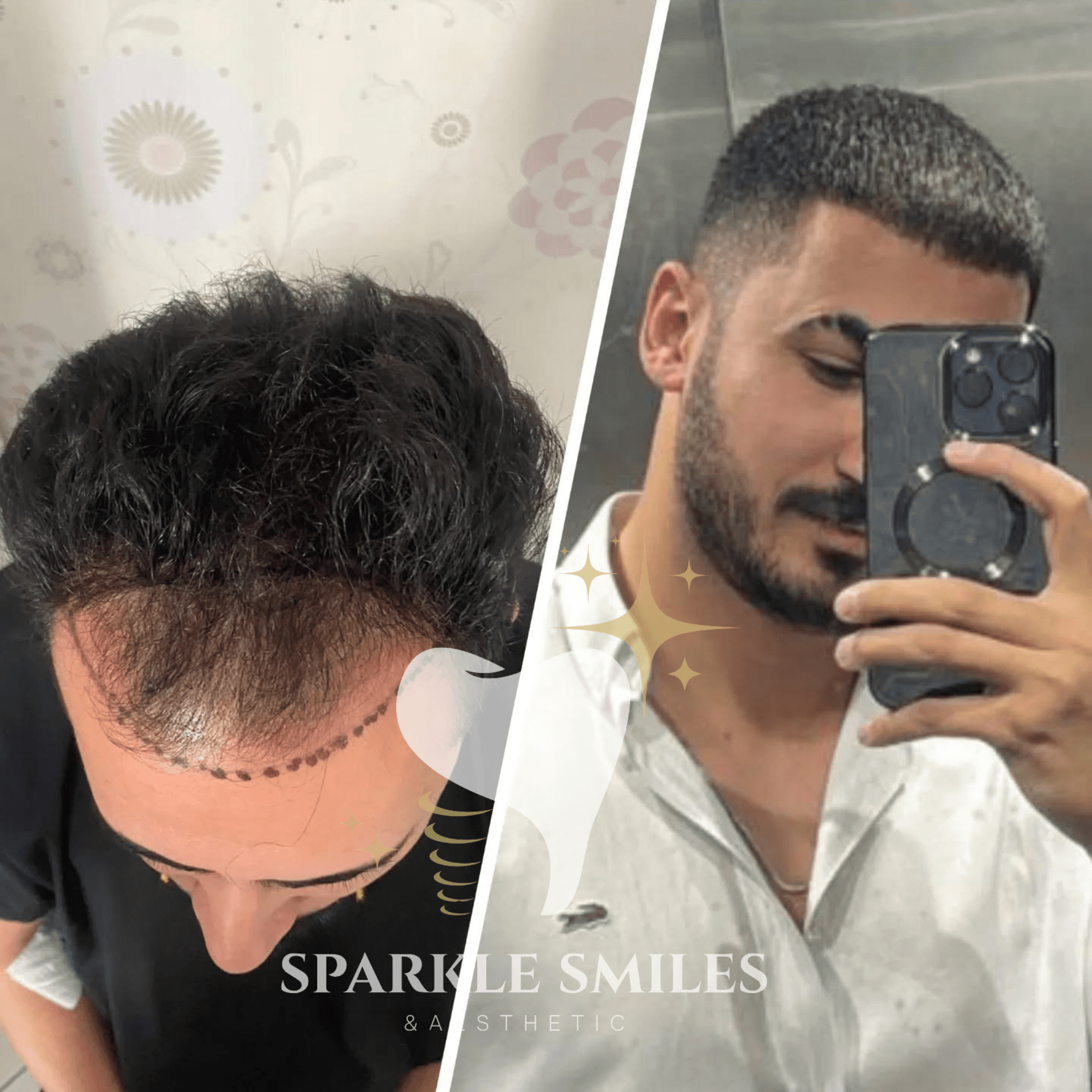 Результат пересадки волос 11