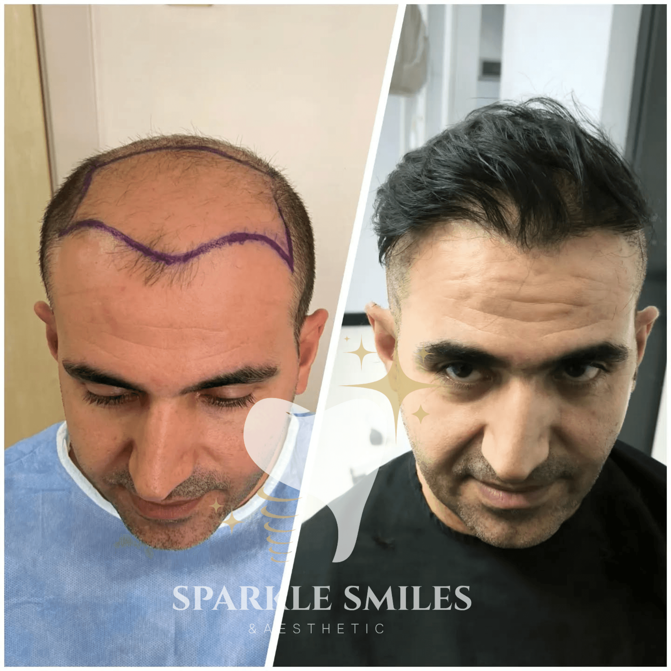 Результат пересадки волос 12