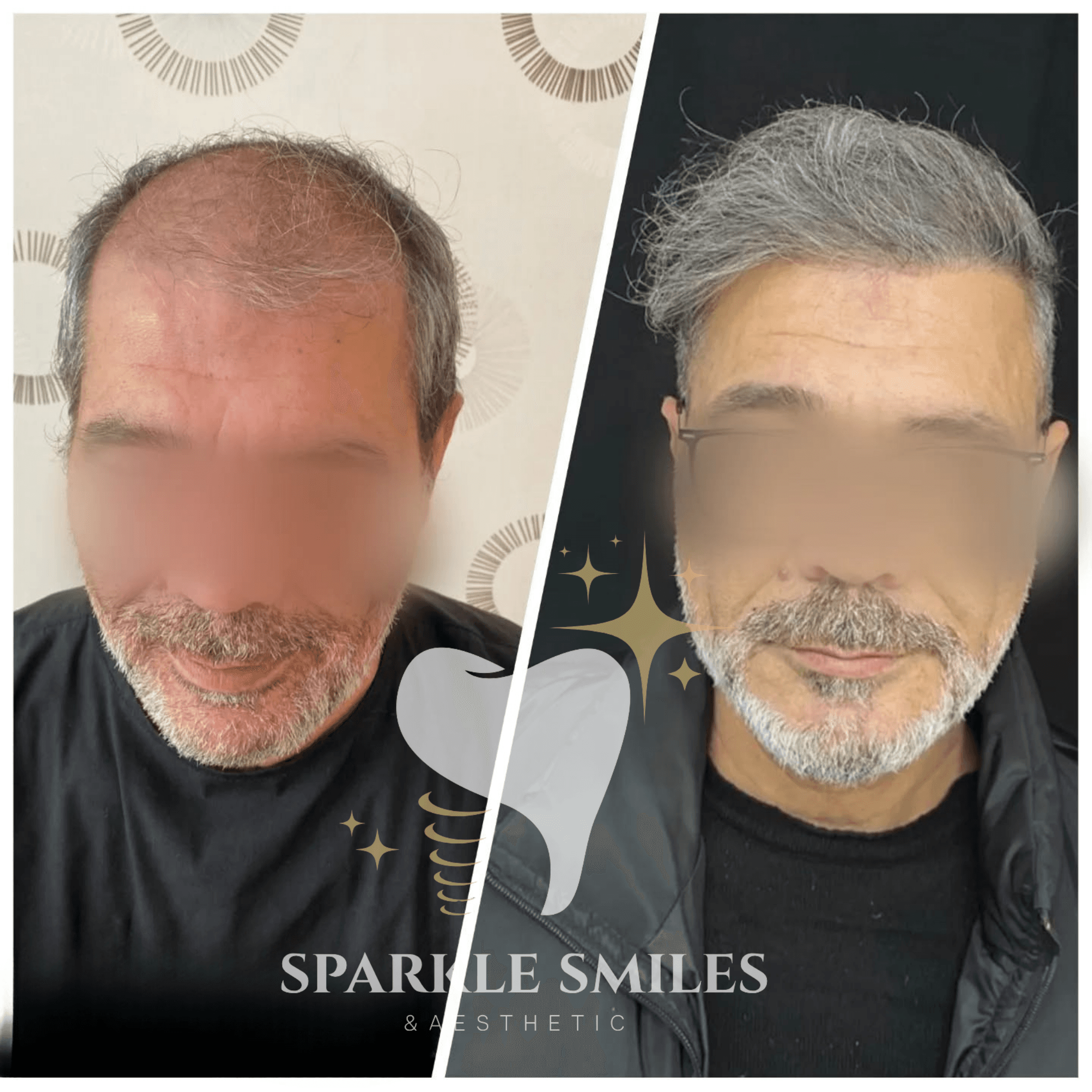 Результат пересадки волос 13