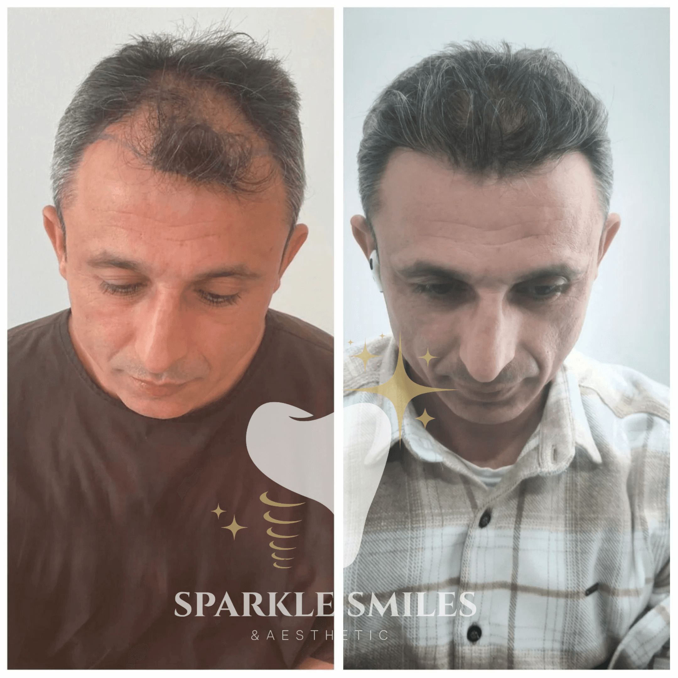 Результат пересадки волос 2