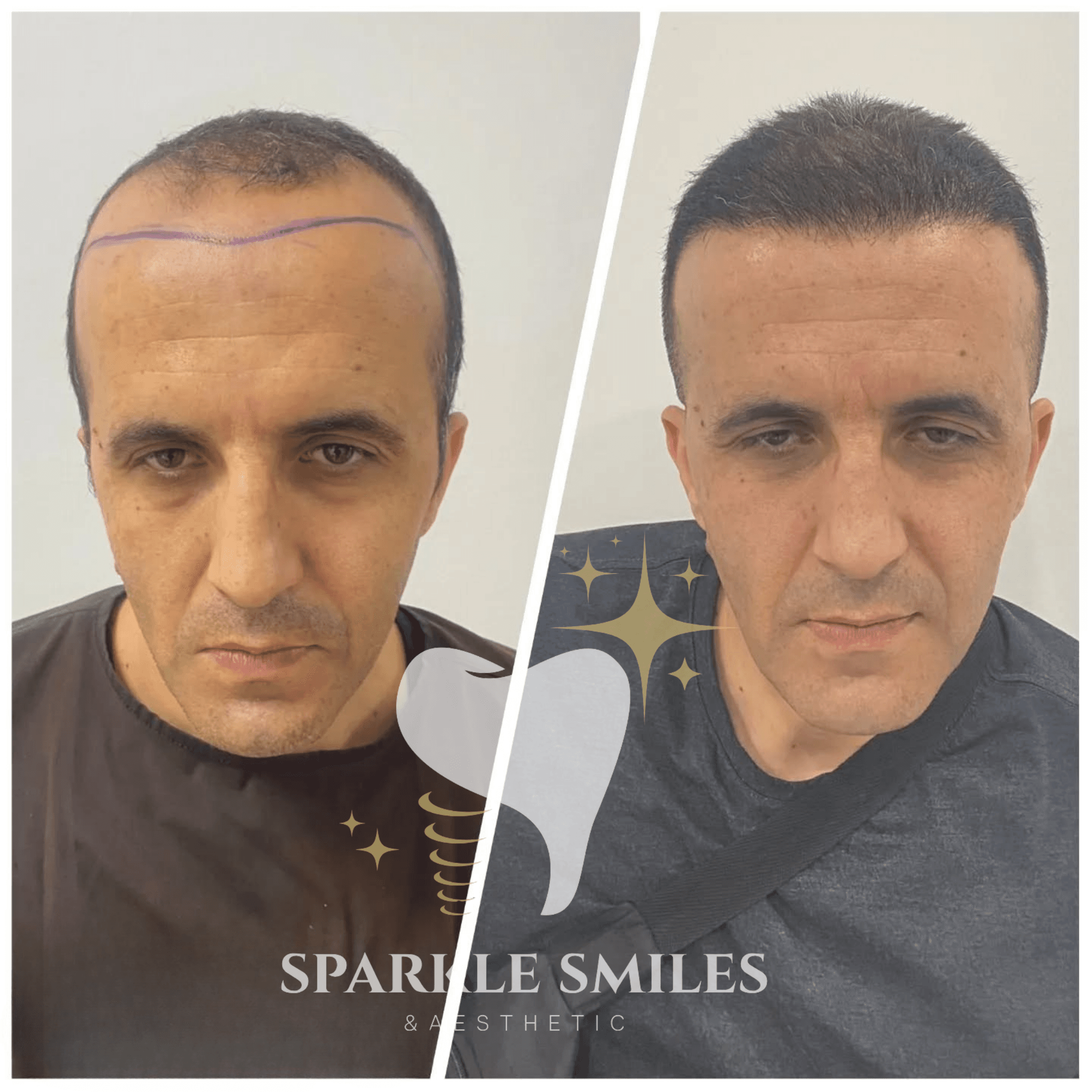 Результат пересадки волос 3