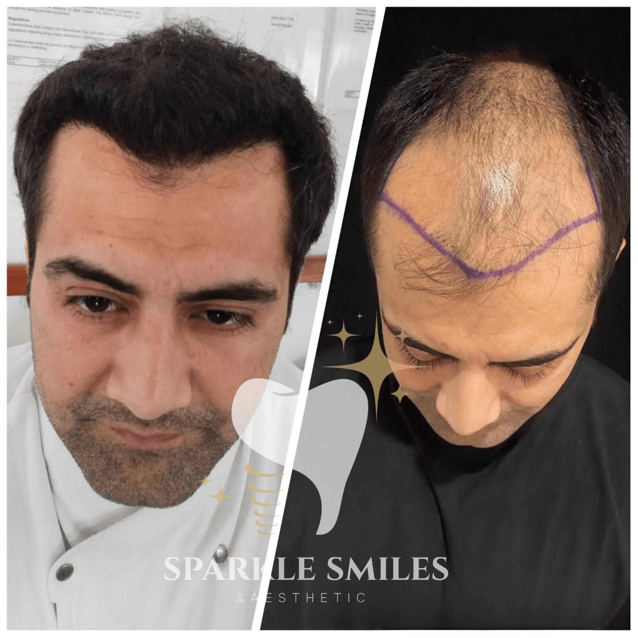 Результат пересадки волос 4