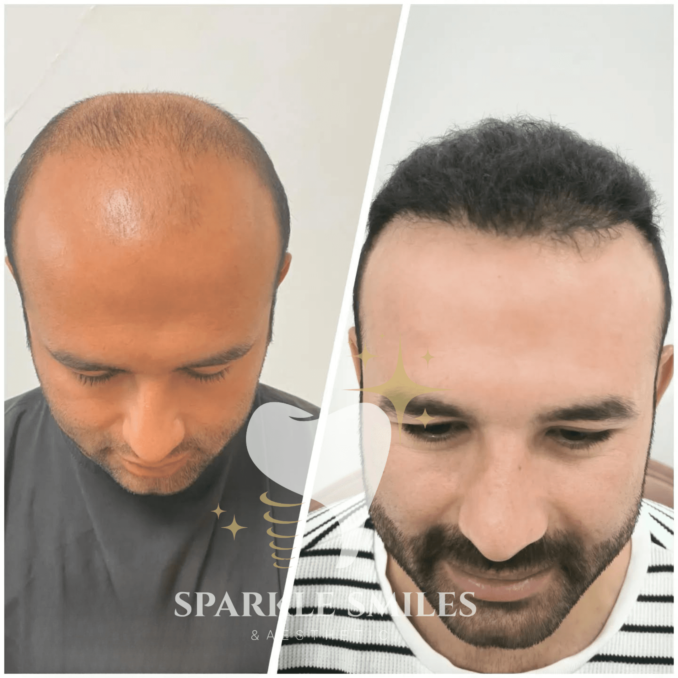 Результат пересадки волос 5