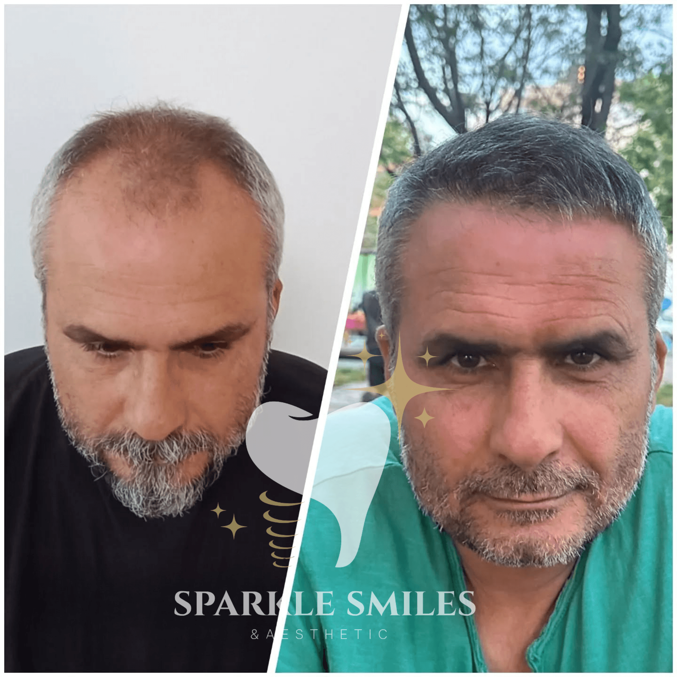 Результат пересадки волос 6