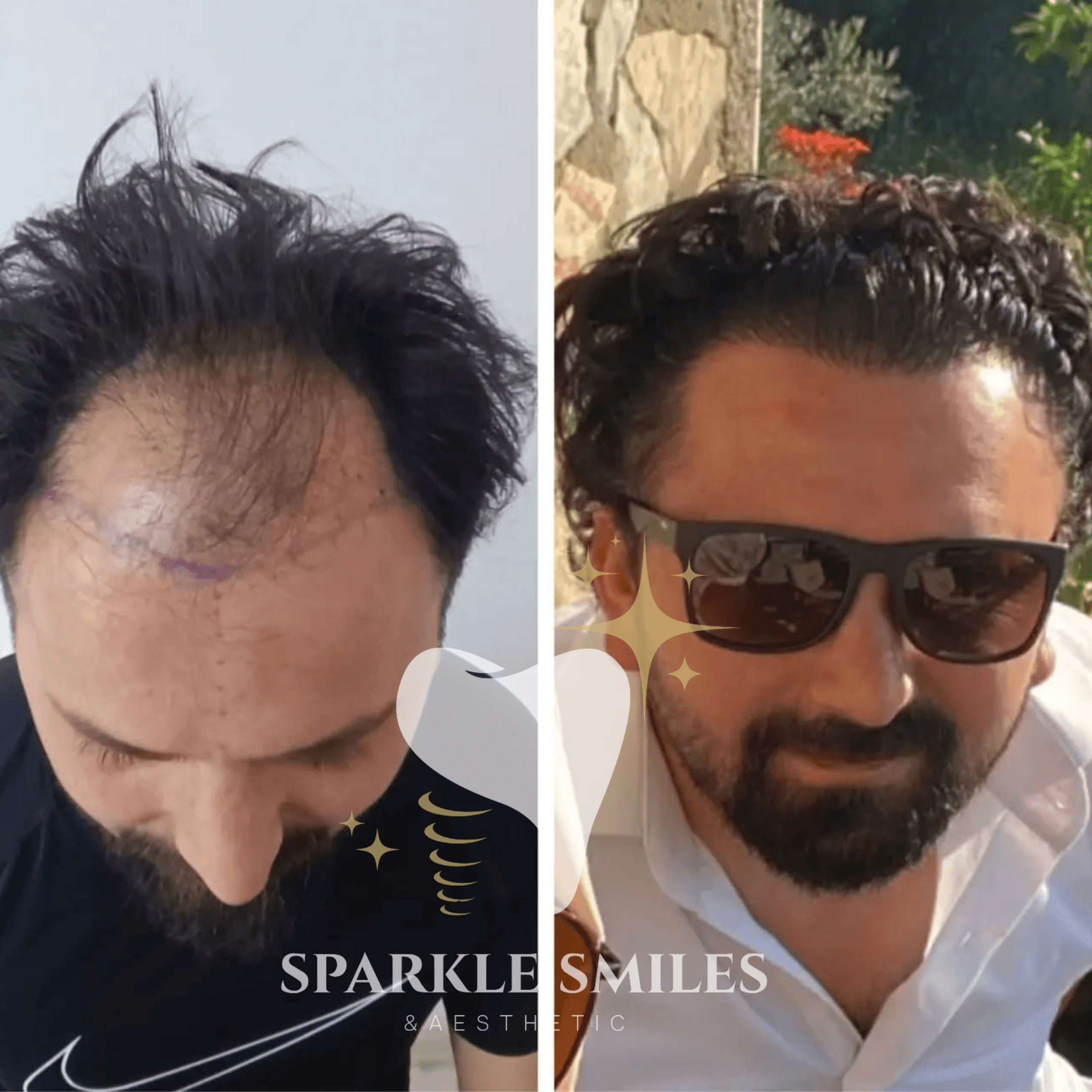 Результат пересадки волос 7