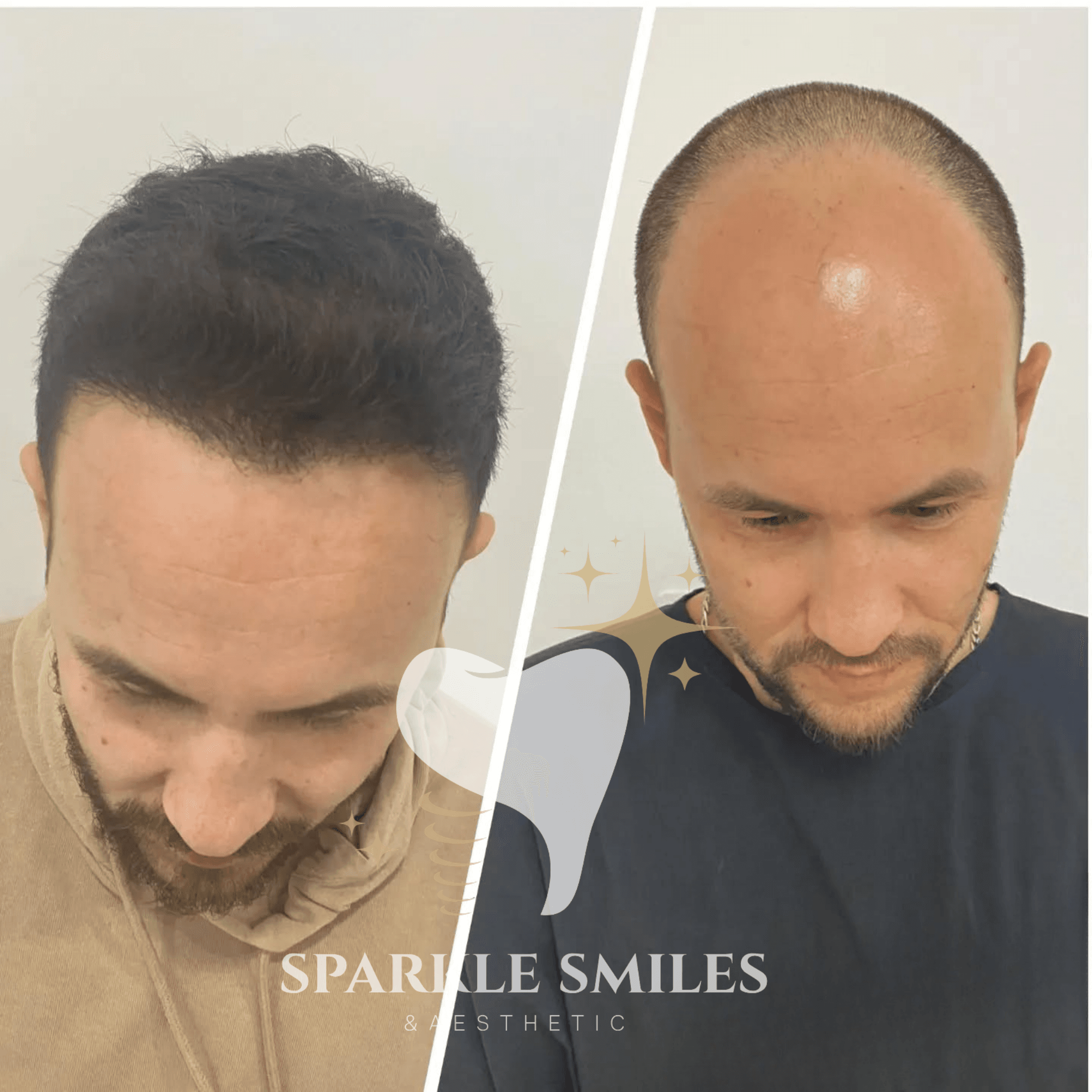 Результат пересадки волос 8