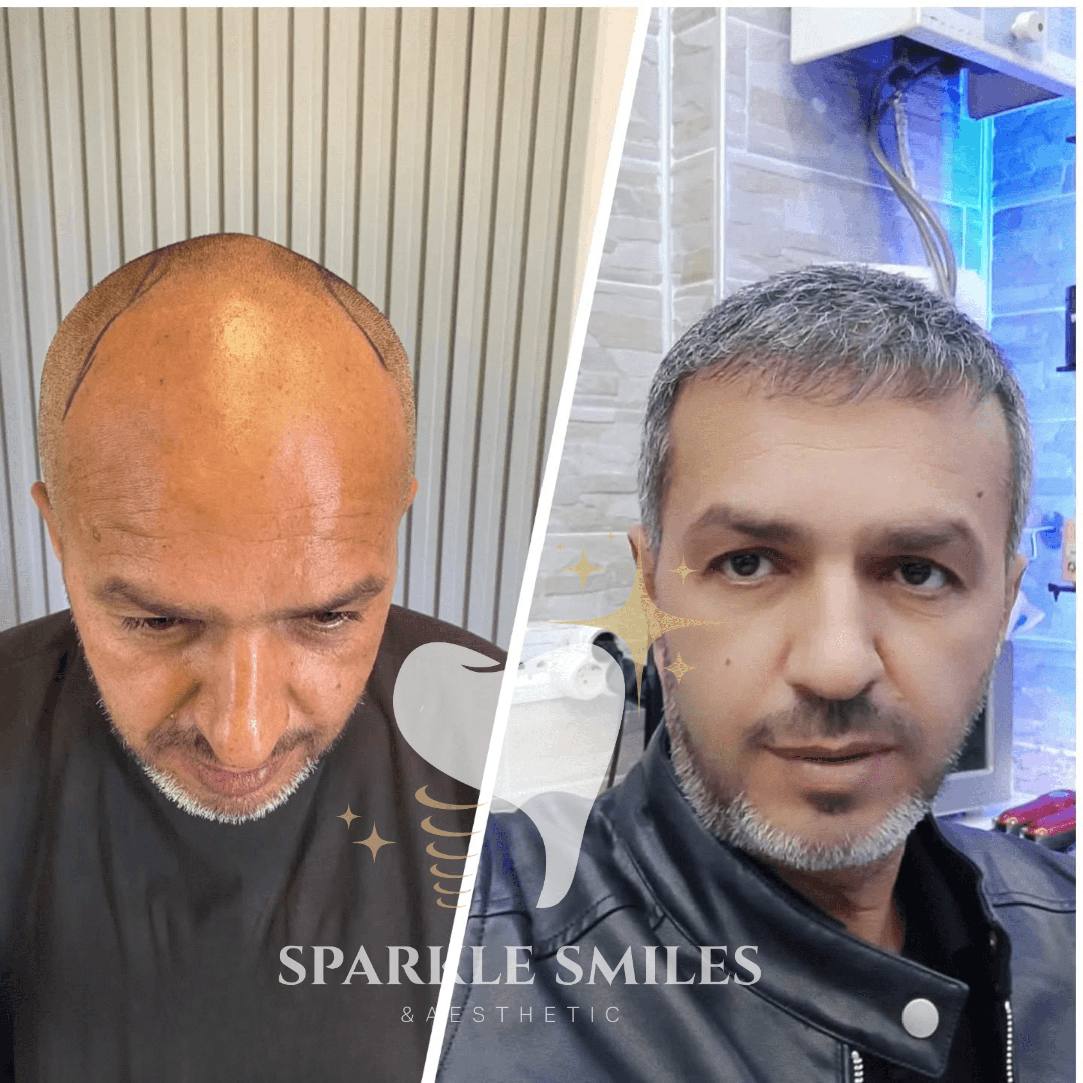 Результат пересадки волос 9